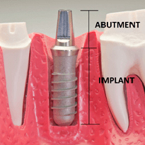 Teeth Replacement