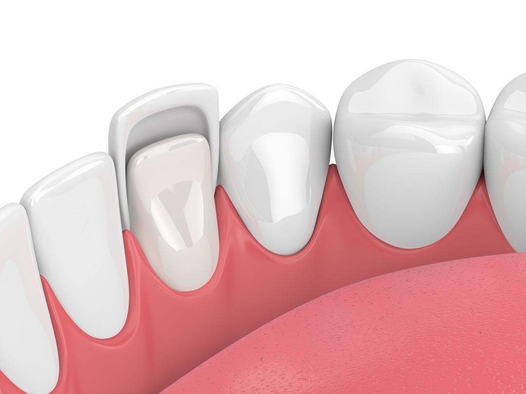 composite dental veneers in singapore