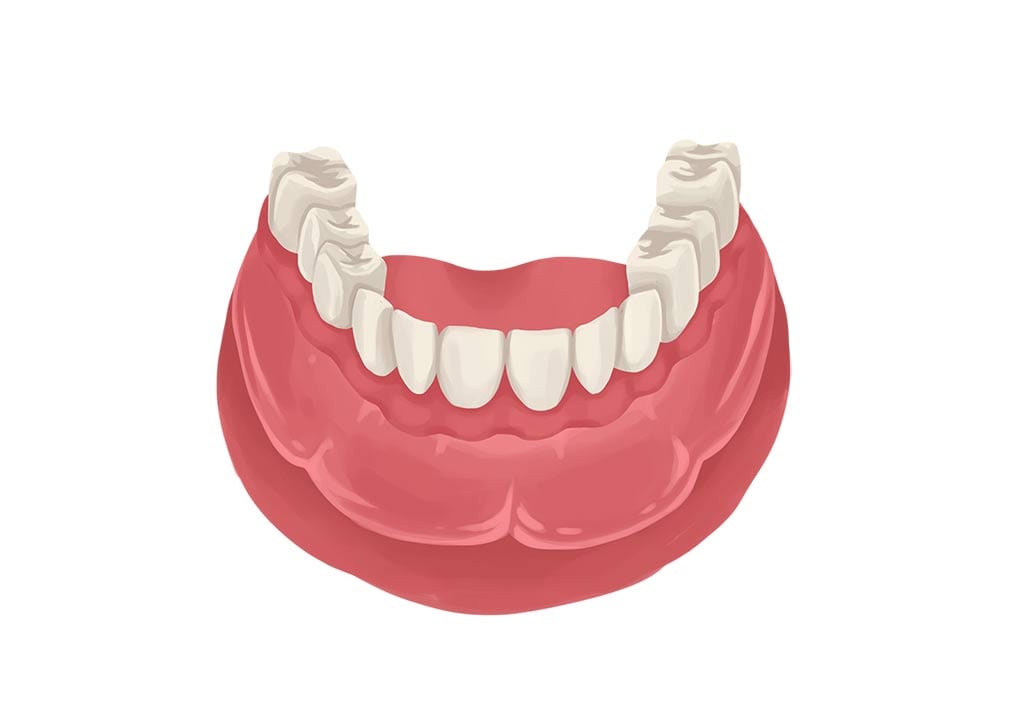 https://www.nofrillsdental.com/wp-content/uploads/2020/10/fixed-implant-denture-no-implants-seen.jpg