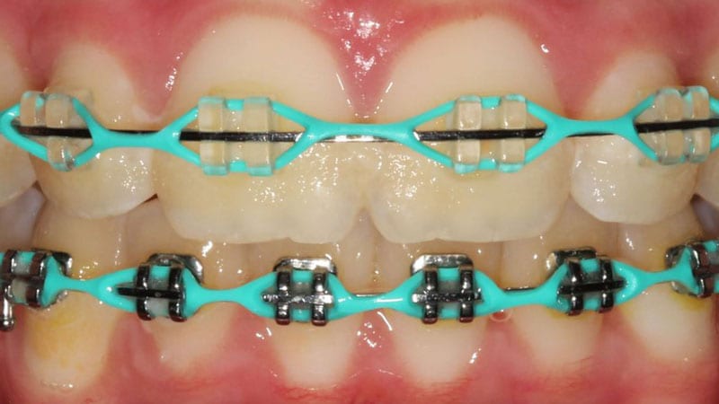 hot pink braces for teeth