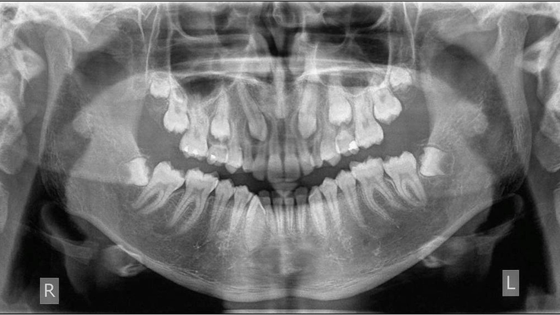 Panoramic X ray