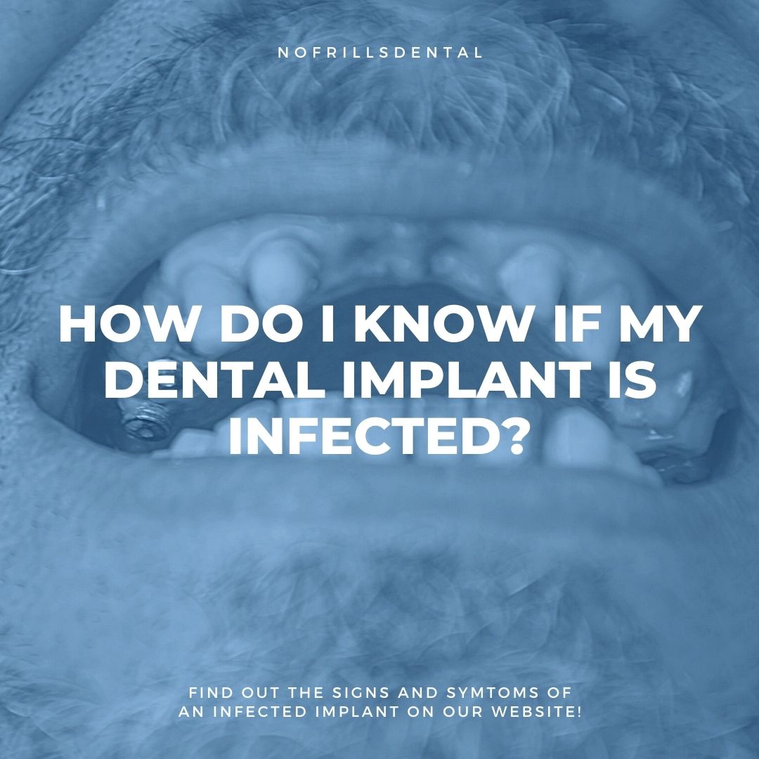 How Do I Know If My Dental Implant Is Infected Nofrills Dental 