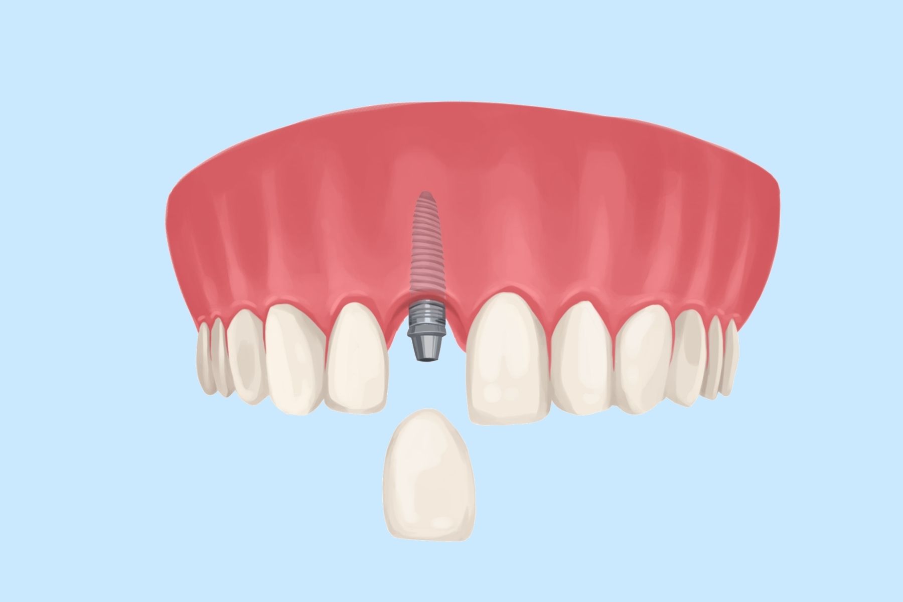 Can Dental Implants Be Used For Front Teeth? - NoFrills Dental