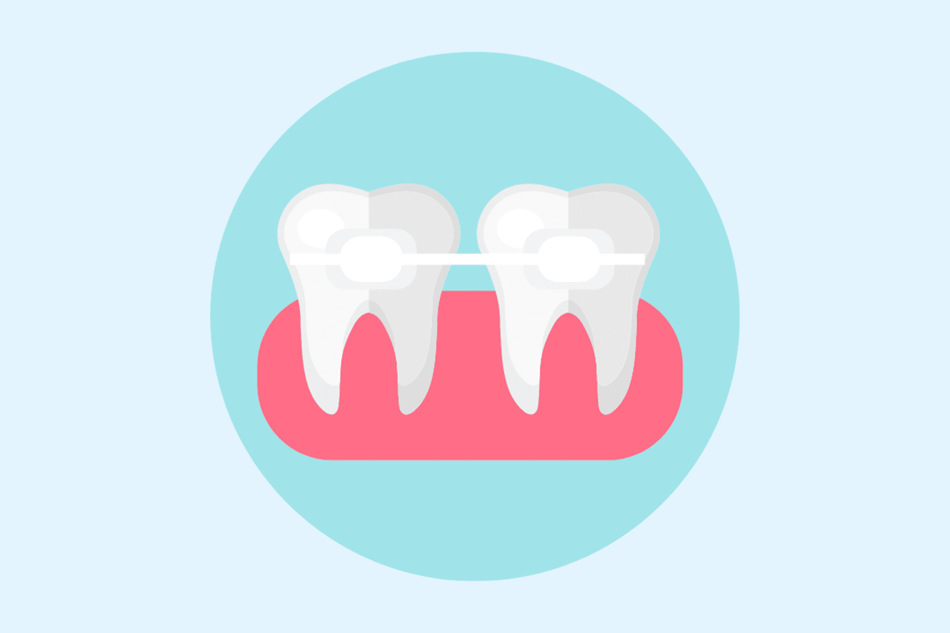 self ligating braces ceramic