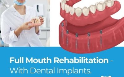 Transform Your Smile: The Guide to Full Mouth Rehabilitation with Dental Implants (2024)