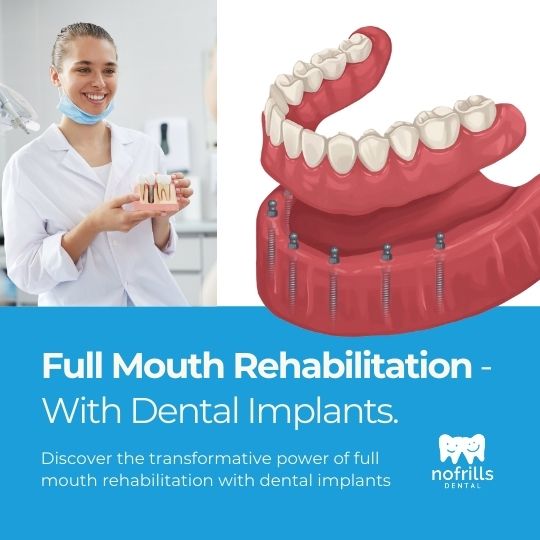 Transform Your Smile: The Guide to Full Mouth Rehabilitation with Dental Implants (2024)