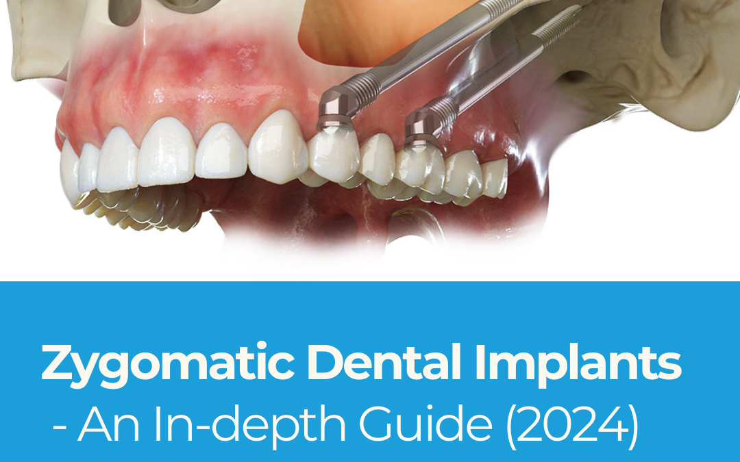 Zygomatic Dental Implants: An In-depth Guide