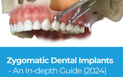 Zygomatic Dental Implants: An In-depth Guide